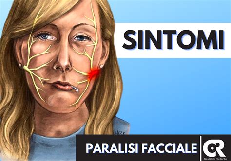 Sintomi Della Paralisi Facciale Riccardo Castellini Fisioterapista