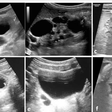 Different Grades Of Vesicoureteral Reflux Elicited By Micturating