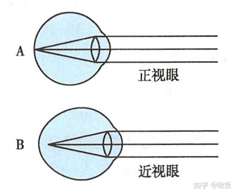 老年时，近视和老花会互相抵消吗？老花和远视是一回事吗？ 知乎