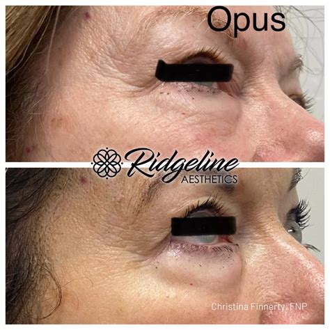 Plasma Skin Tightening Ridgeline Aesthetics A Premier Med Spa