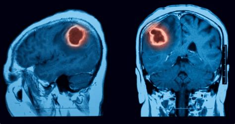 ¿tumor Cerebral Maligno Tiempo De Vida Open Ai Lab