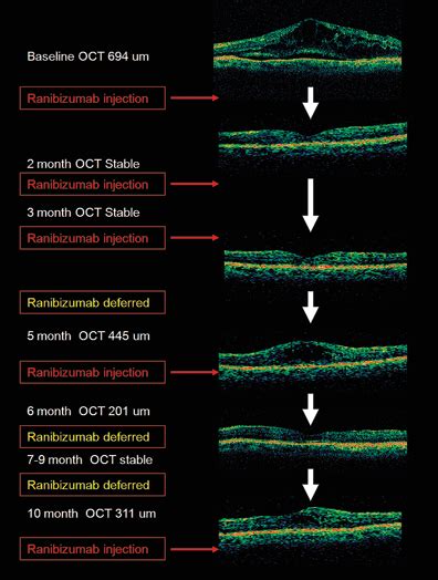 15 Anti Vegf Therapies In Diabetic Macular Edema Ento Key