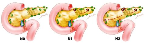 Stage And Grade Pancreatic Cancer Johns Hopkins Pathology