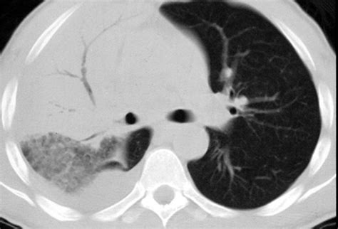 Thoracentesis Best Practices Slideshow