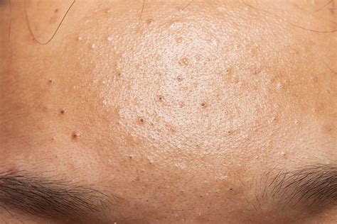 Understanding Blackheads And Whiteheads Vinmec