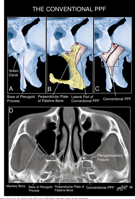 Figure From Osseous Anatomy Of The Pterygopalatine Fossa Semantic