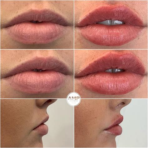 Marco Cosmetic Nurse Injector On Instagram “first Time Lip Filler For This Young Woman Today