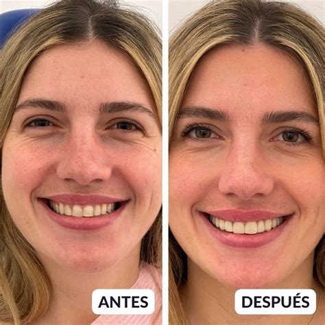 Carillas Dentales Valencia Clinica Dental Dra Adriana Saiz