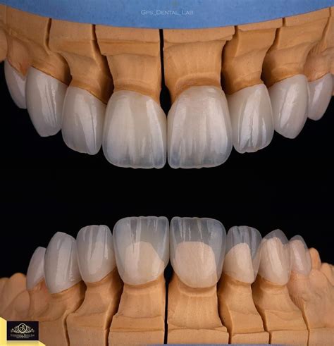 Emax Crowns And Veneers ️emax Ceram Shade B1 ️veneers Max