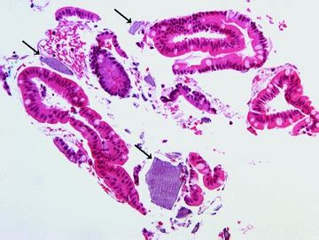 Superficial Ileal Mucosal Biopsy With Intact Villi And Many Kayexelate