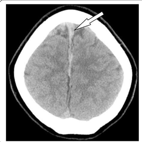 Pdf Intracranial Subdural Hematoma After Epidural Anesthesia A Case Report And Review Of The