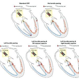 Schematic Representation Of The Simulated Pacing Locations The