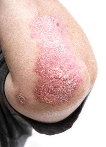 Psoriasis Elbows Stock Photos, Pictures & Royalty-Free Images - iStock