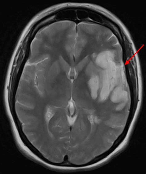 Brain lesions causes, brain lesions diagnosis and brain lesions treatment