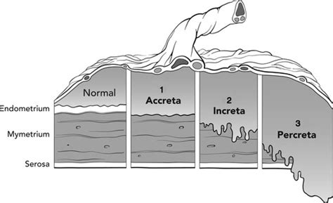 Figo Consensus Guidelines On Placenta Accreta Spectrum Disorders