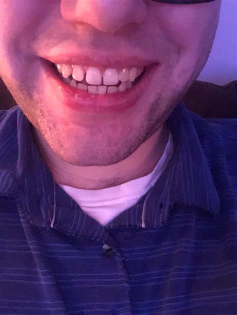 I’m Getting Invisalign To Fix My Midline Shift It Mainly Bothers Me That My Chin Is A Bit