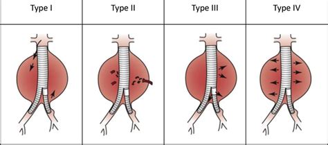 Endovascular Aortic Aneurysm Repair A Review Of Anesthesia Concerns