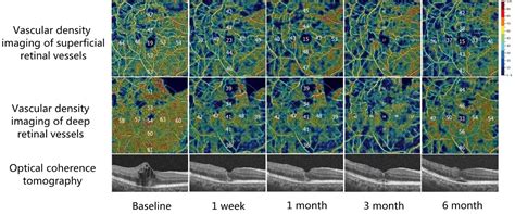 Figure 1 From Effect Of Conbercept Treatment On Macular Edema And