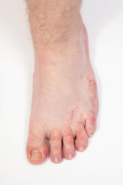 Premium Photo Dermatitis On Foot Athlete S Foot Disease