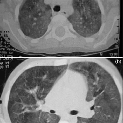 Hemosiderin Laden Macrophages Were Demonstrated In Bronchoalveolar