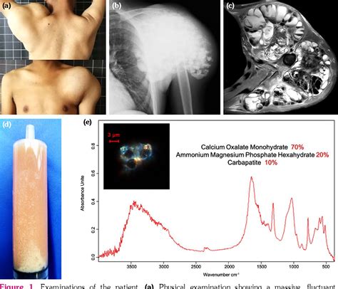 Figure 1 From Uremic Tumoral Calcinosis A Case Report Semantic Scholar