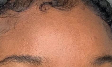 How Can I Get Rid Of These Textured Bumps In My Forehead And Chin R