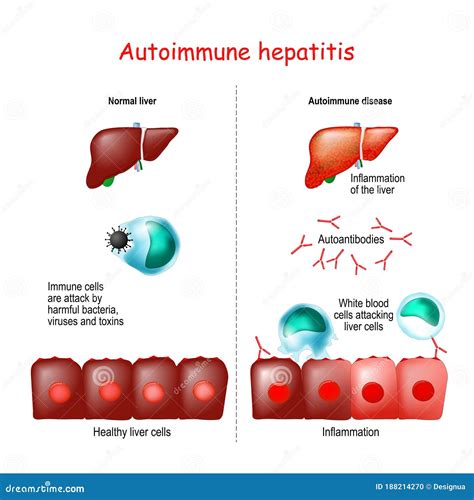 H Patite Auto Immune Illustration De Vecteur Illustration Du Humain