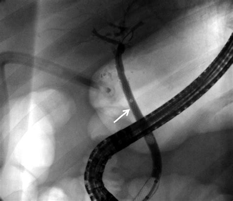 Cholangiogram Performed During Ercp Demonstrating Placement Of 8 Mm × Download Scientific