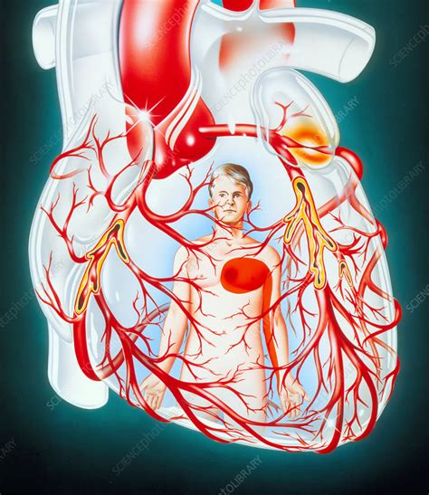 Illustration Of Heart Showing The Cause Of Angina Stock Image M172