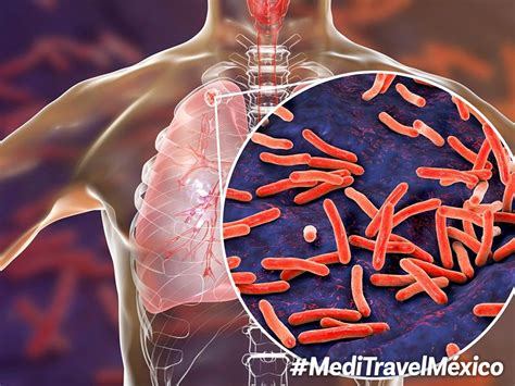 La Tuberculosis Es Curable Si Se Trata A Tiempo Secretar A De Salud