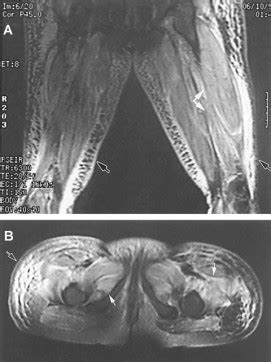 Juvenile Dermatomyositis Presenting With Anasarca A Possible Indicator