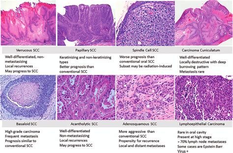 Pathology Outlines Squamous Cell Carcinoma Scc