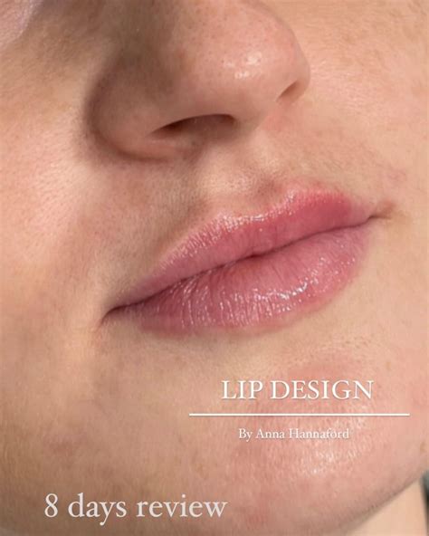 Lip Filler Near Me Top Rated Lip Filler Treatments At House Of Beauty