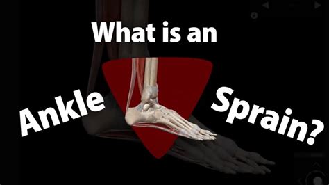 Visible Body 3 Ankle Sprain Symptoms Youtube