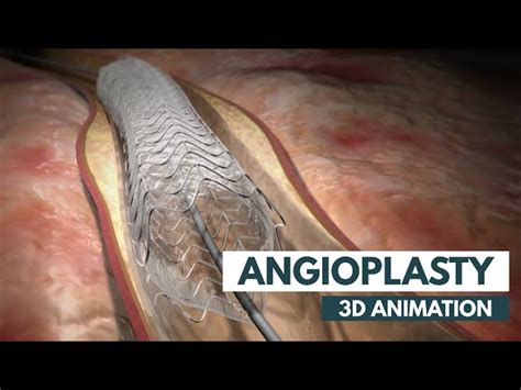 Angioplasty Procedure Benefits And Risks Schooltube