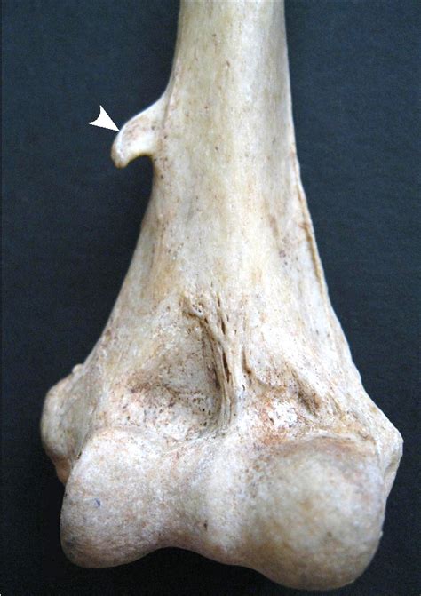 Figure 2 From Supracondylar Process Of The Humerus A Case Report