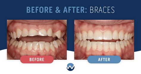 How Braces Change Face Shape Before After