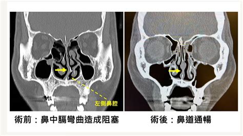 內視鏡微創手術治療鼻中膈彎曲 偏頭痛與鼻塞不藥而癒