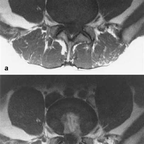 A B Postoperative Spinal Neural Foramen Stenosis A Axial B