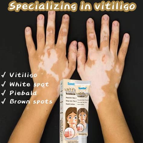 Vitiligo White Spot Repigmentation Krim Bintik Putih Untuk Vitiligo