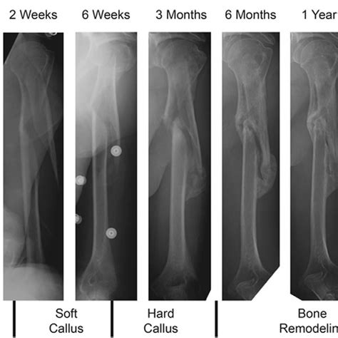 Schematic Of The Phase Conceptual Model For Bone Fracture Healing By