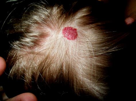 What Is A Hemangioma What Are The Causes Of Hemangioma The Dynamic