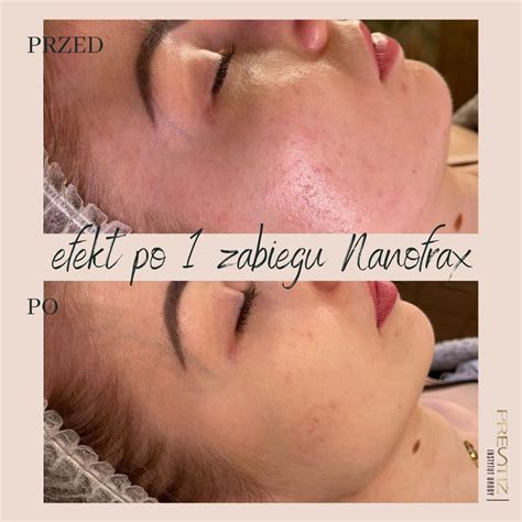 Mezoterapia Mikroig Owa Nanofrax Presti Skin Clinic Presti