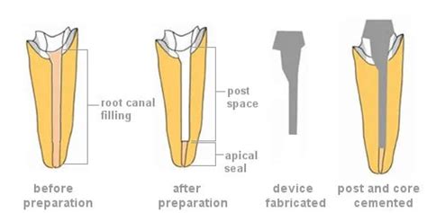 How is a Post and Core Designed and Executed?