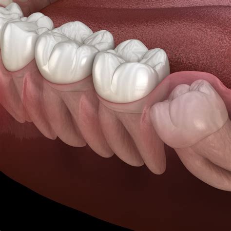 Tudo o que você precisa saber sobre os dentes sisos causas sintomas e