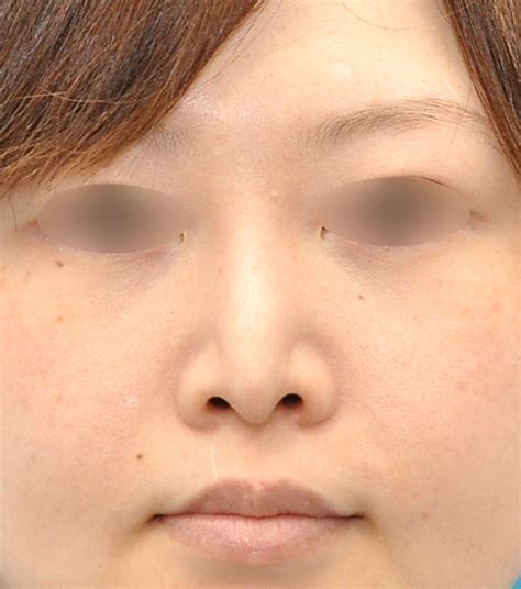 鼻の整形 施術から探す 美容整形や美容外科なら親身な診療の加藤クリニック麻布 東京大阪