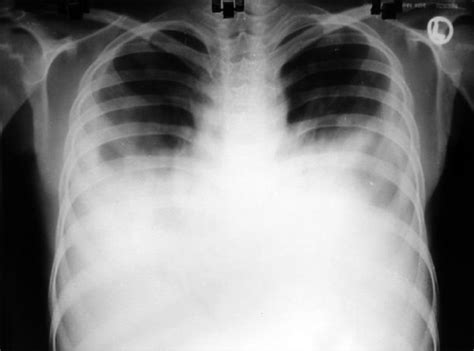 Chest X Ray Right Pleural Effusion And Bilateral Reticular Infiltrates