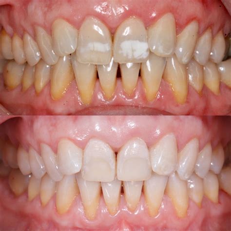 Antes Y Despu S En Tratamientos Dentales Cl Nica Dental Mozas Vitoria