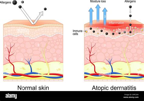 Atopic Dermatitis Eczema Cross Section Of Normal Skin And Dry Skin Inflammation Vector