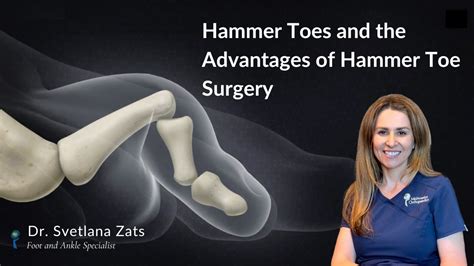 What Is A Hammer Toe What Are The Advantages Of Hammer Toe Surgery